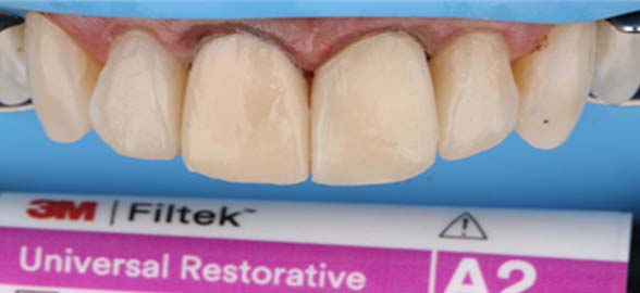 3M: Scopri la gamma di compositi Filtek per i tuoi restauri dentali