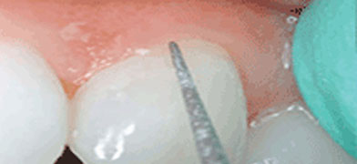 Todo lo que debes saber sobre cementos dentales (V): Cemento de resina
