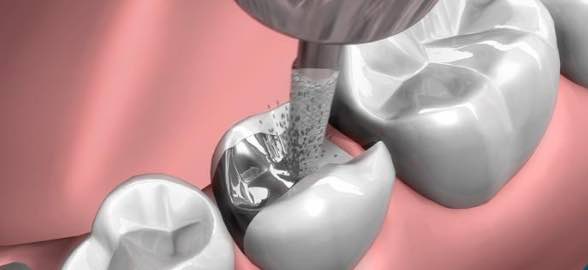 La aleación de amalgama dental en la actualidad: actualiza tus conocimientos