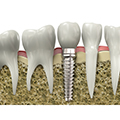 Biomaterial para implantes
