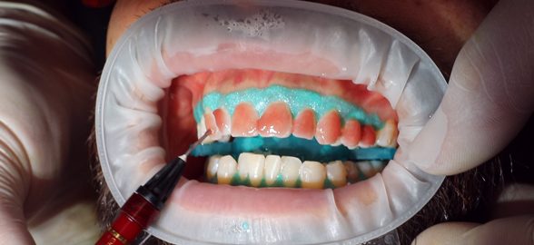 Vidéo : Les meilleures pratiques pour le blanchiment dentaire en clinique