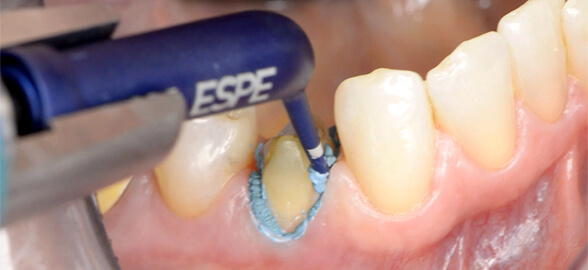 Astringents in dentistry: How to achieve effective gingival retraction