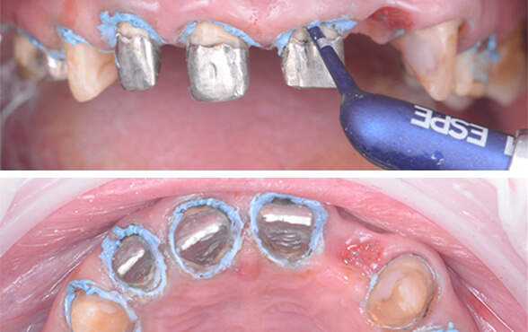 Gingival recession