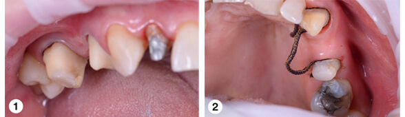 Gingival recession