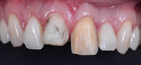 Gingival Retraction