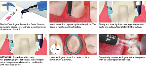 Gingival Retraction