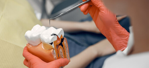 Ciments de scellement pour l'endodontie : tout ce qu'il faut savoir pour choisir le meilleur