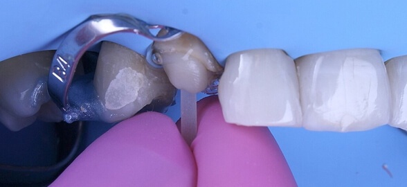 Guía completa sobre postes de fibra de vidrio en odontología