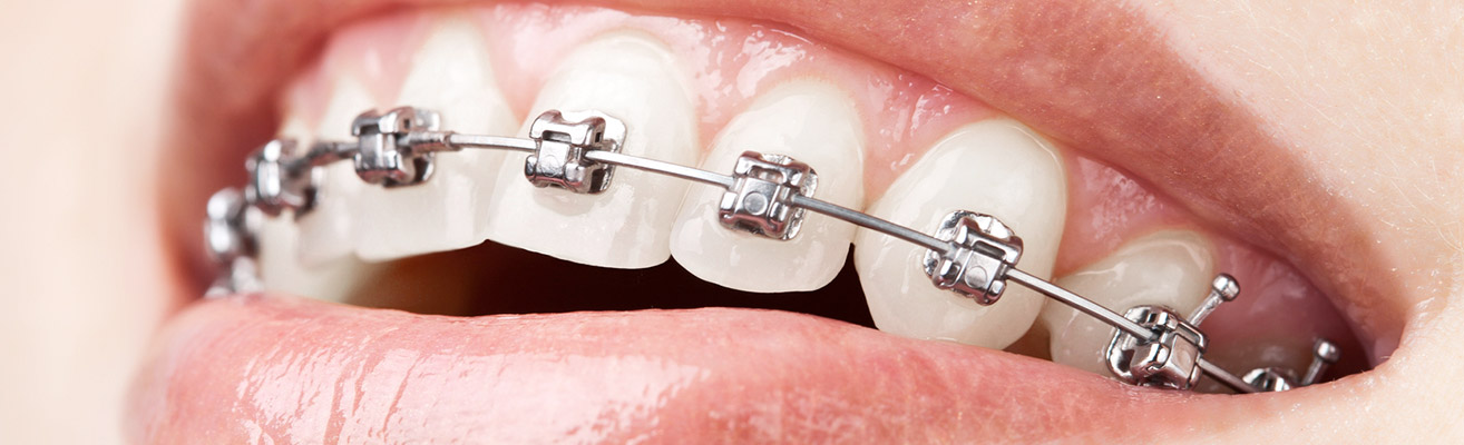self-ligating brackets