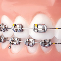 brackets-metalliques-conventionnels
