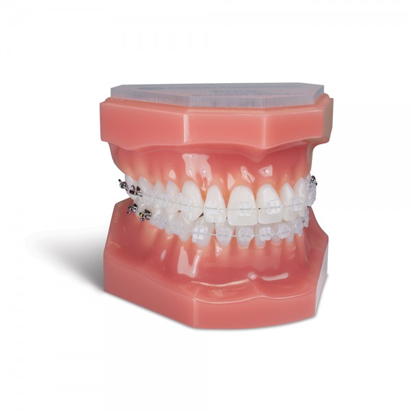 aesthetic sapphire brackets