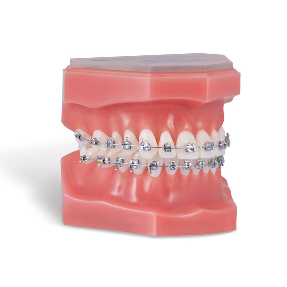 metal brackets