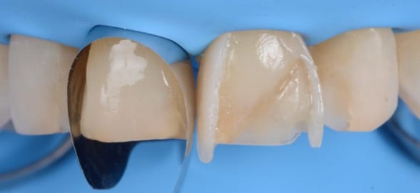 Direct dental composite veneers: advantages and disadvantages compared to other materials