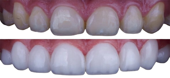 Composites indirects : restauration esthétique et durable en dentisterie