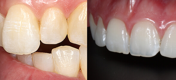 Des cas cliniques avec Filtek Easy Match de Solventum (3M Health Care)