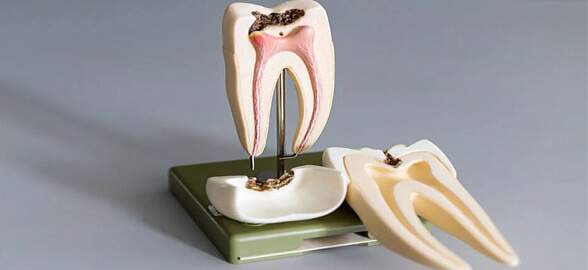 Cementi MTA: il materiale sviluppato per l'endodonzia