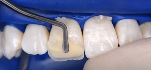Anterior and posterior teeth composites VS universal composites: the basic differences