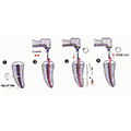 Condensation of gutta percha