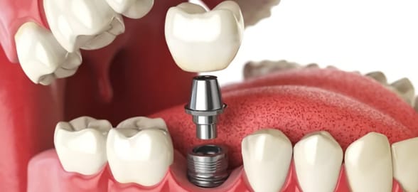 What special care should patients with dental implants have?