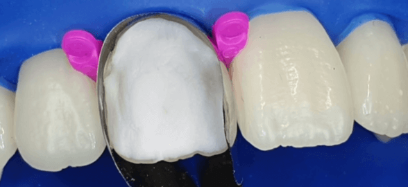 3M Filtek Universal Restorative : Le composite qui promet de vous faciliter la vie