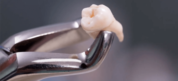 Les différents types de forceps dentaires et leur utilité
