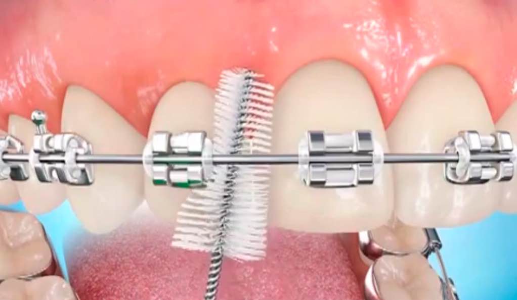 higiene bucal brackets