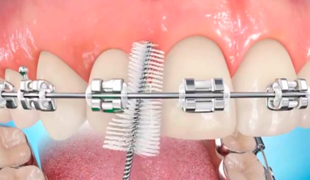 oral hygiene brackets
