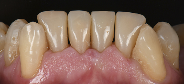 Facettes directes selon la technique du composite injecté : Cas clinique avec Filtek Easy Match Fluide