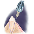 Anesthesia intraligamentaria