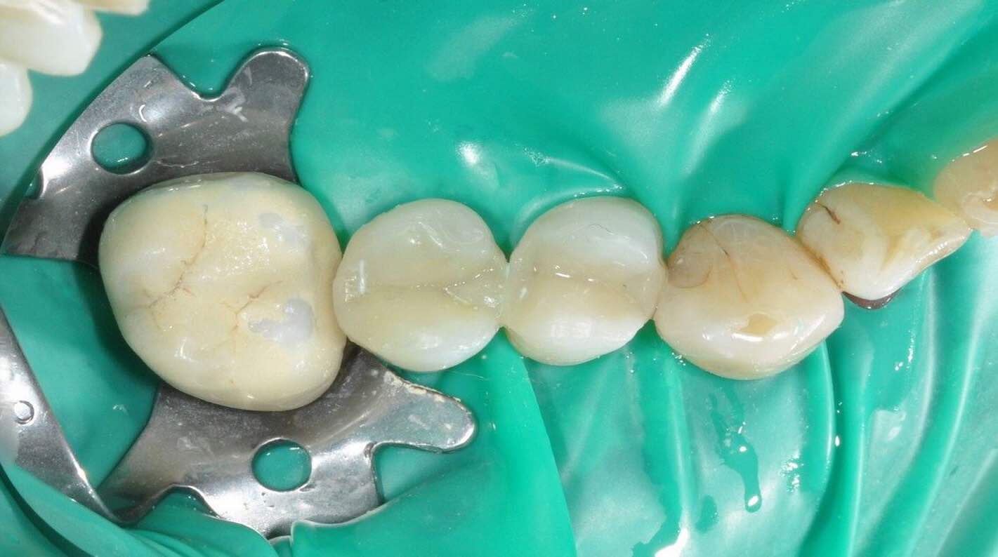 Clamps dentales