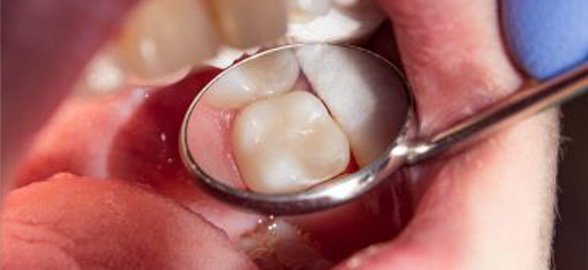 Cementos dentales de Medicaline: ¡conoce sus características y ventajas!