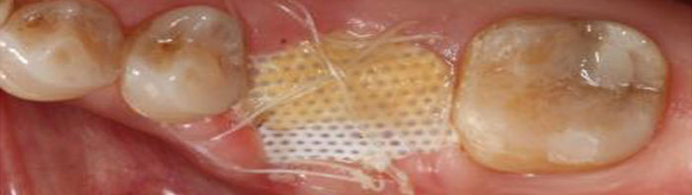 cas clinique membranes en PTFE