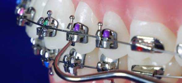 Self-ligating brackets: the importance of friction in orthodontic treatment
