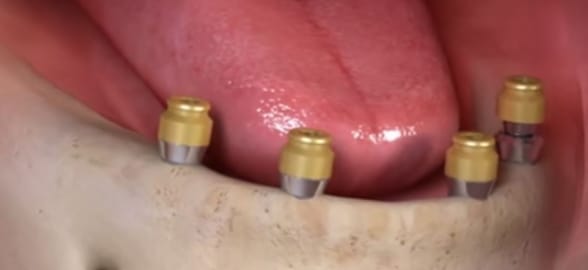 ¿Qué son los pilares Locator para Implantes y para que se utilizan?