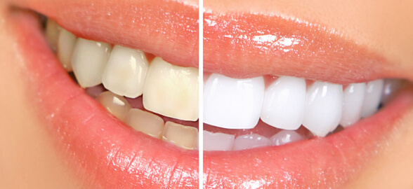 Guide complet du blanchiment des dents : types, procédures et recommandations