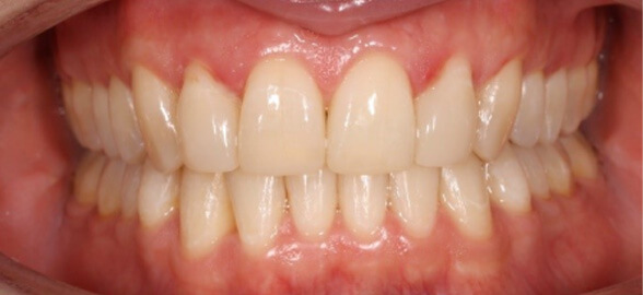 Cómo mejorar tus restauraciones dentales con composite calentado: más precisión, estética y durabilidad