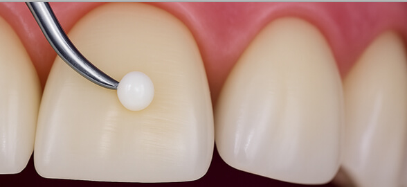 Composites dentaires : un guide complet des types, des utilisations, des avantages et des applications en dentisterie