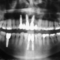 Radiographie Dentaire