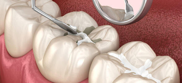 Guide complet des scellants dentaires : prévenir les caries dentaires