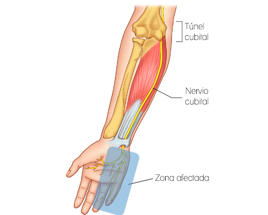 Sindrome del tunel cubital