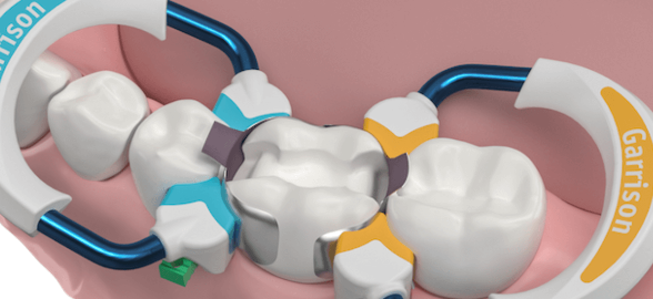 La guida definitiva sulle matrici dentali: scegli la migliore per ogni caso