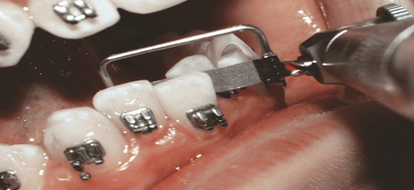 ¡Todo lo que necesitas saber sobre el stripping dental en un solo lugar!
