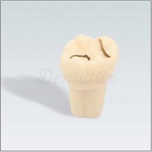 Diente Nº16 con Caries de Fisura Maxilar para Tipodonto