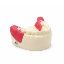 Modelo de Extração de Dentes Retidos e Semirretidos