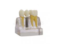 Modèle de démonstration implants-ponts