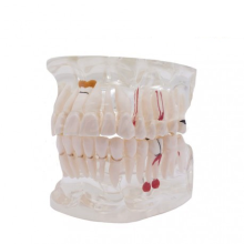 Typodonto Transparent avec Implant