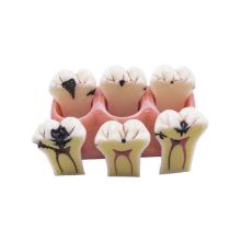 Modèle Amovible de Caries