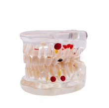 Type démonstratif Caries