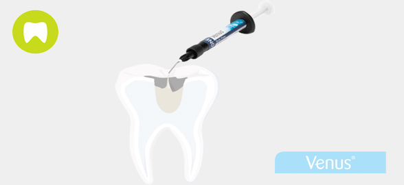 Composites Venus de Kulzer: ¿Qué son y por qué harán de tus restauraciones dentales un procedimiento más sencillo y rápido?