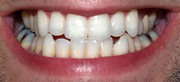 Todo lo que debes saber sobre cementos dentales (II): Cemento de Fosfato de Zinc